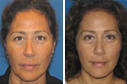 Before & After Photos